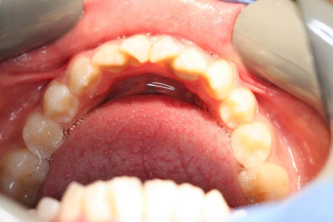 Case 19 Canines placed high and out Teeth N Braces