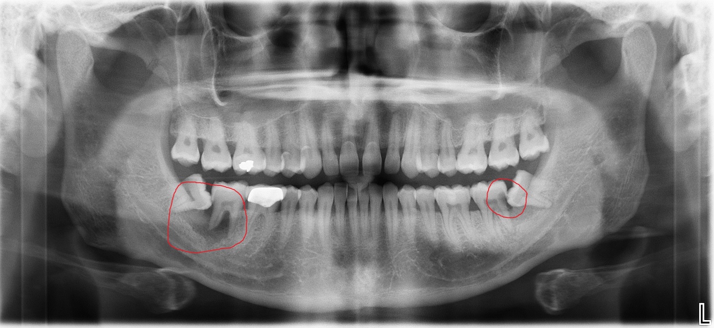 Oral Surgery Blog Temecula, Murrieta CA Temecula Oral