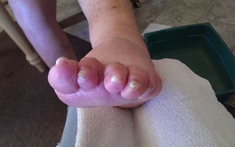 Medical Pedicures Pedicures Boise, Idaho 208853TOES