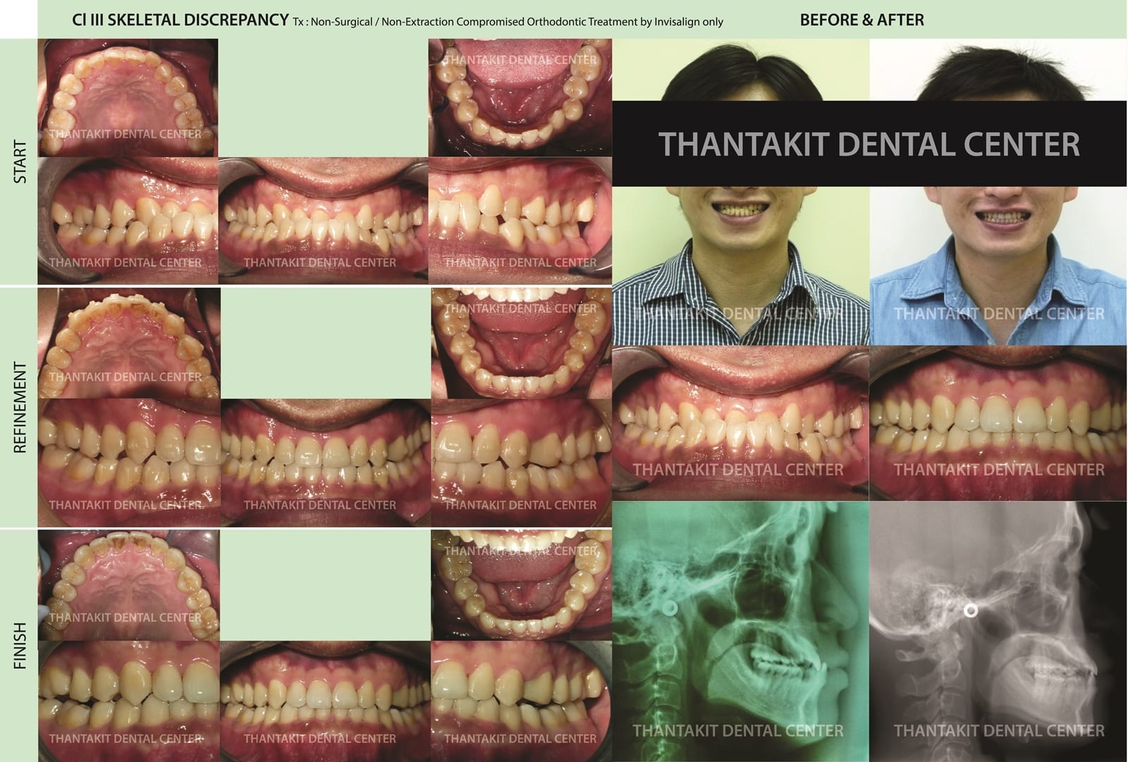 Invisalign in Bangkok, Thailand Thantakit