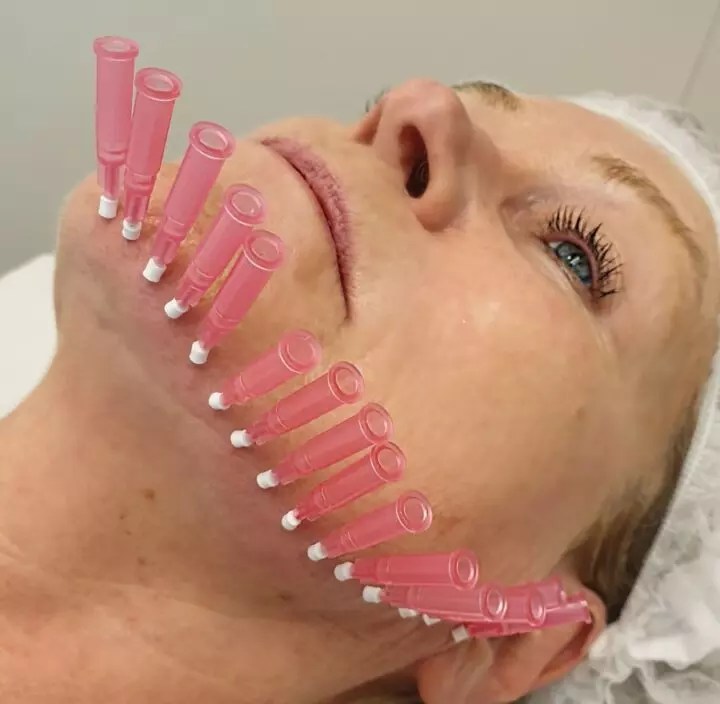 Threads Versus Fillers Comparing the Pros and Cons of Nose Fillers and