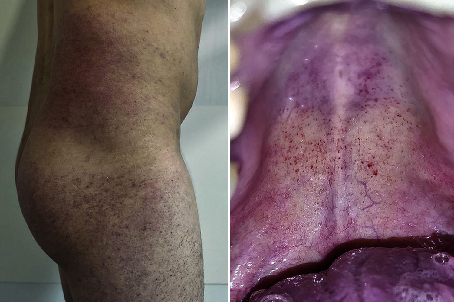 Red rash in the MOUTH could be new coronavirus symptom, docs warn