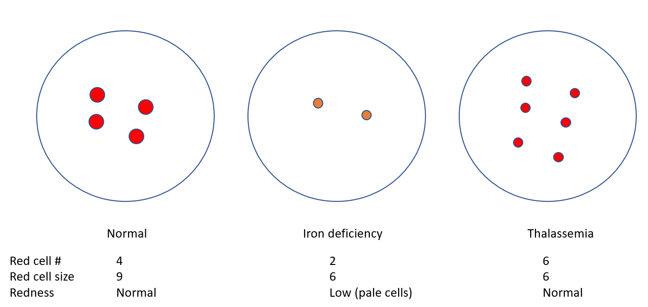 Iron Deficiency Anemia vs. Thalassemia Minor • The Blood Project
