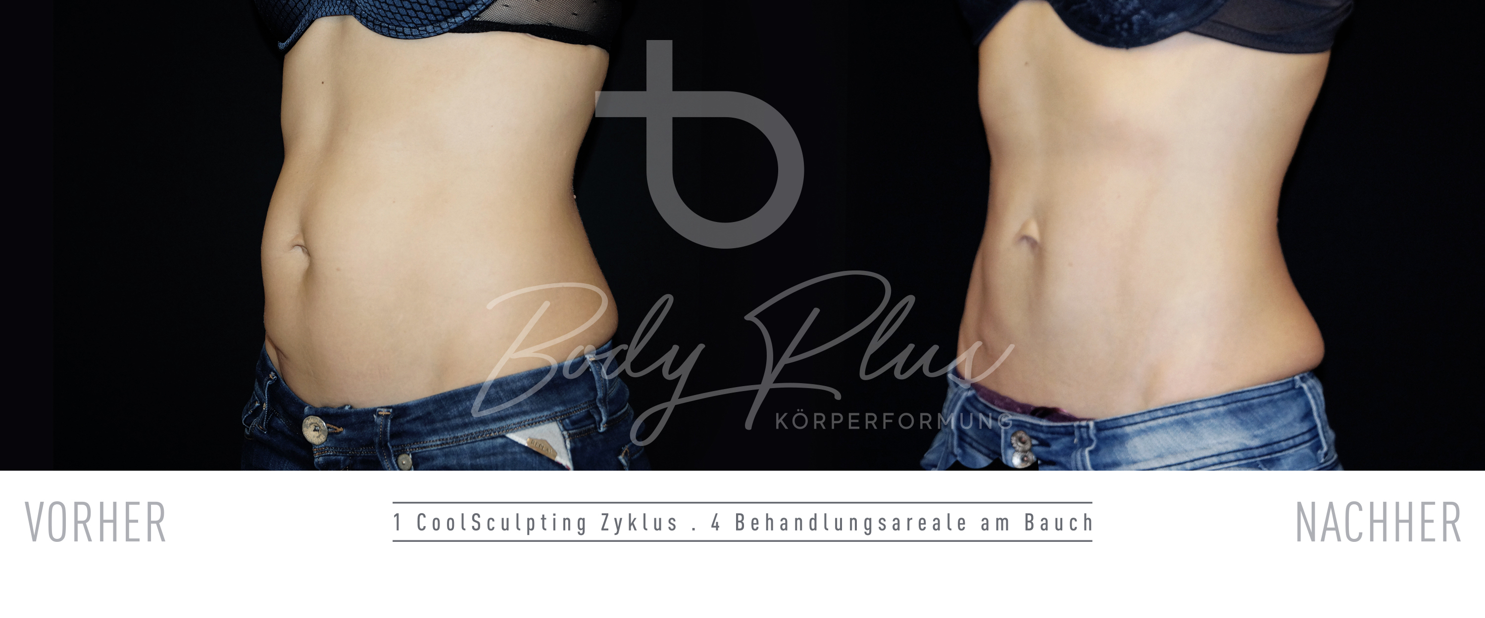 CoolSculpting VorherNachher Fotos CoolSculpting Kryolipolyse Center