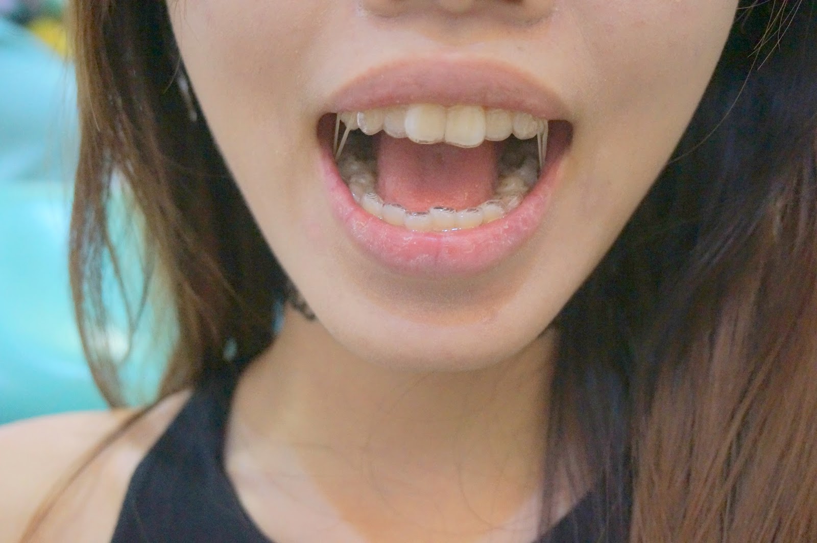 Invisalign Rubber Bands Everything You Need to Know The Braces Guide
