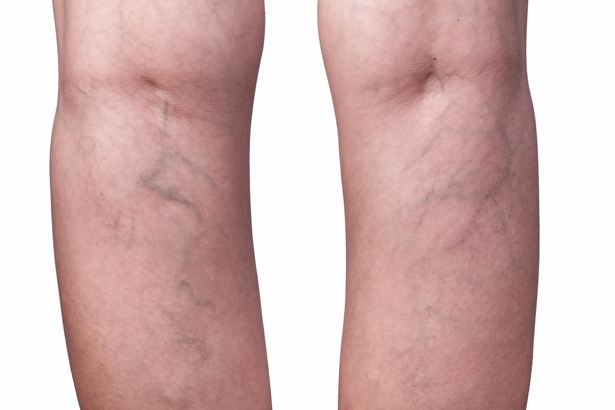 Veins Winnipeg The Derm Centre