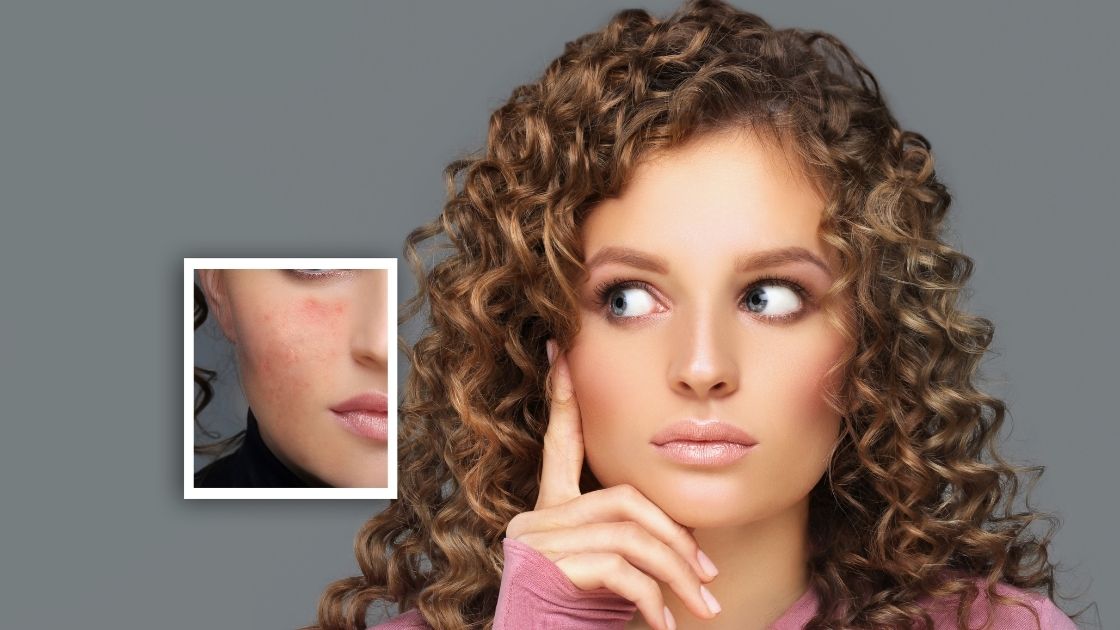 How To Get Rid Of Old Acne Scars (DIY) The Detox Lady
