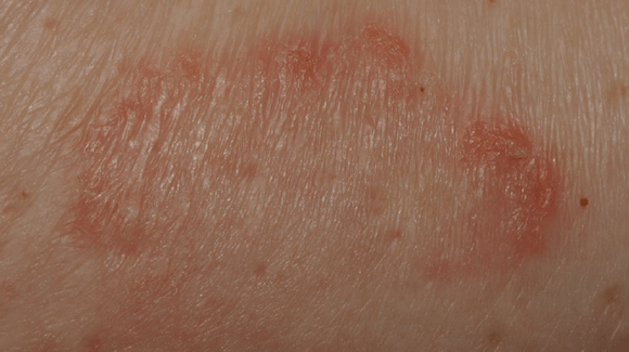62YearOld Female with Itchy Rash on Trunk The Doctor's Channel
