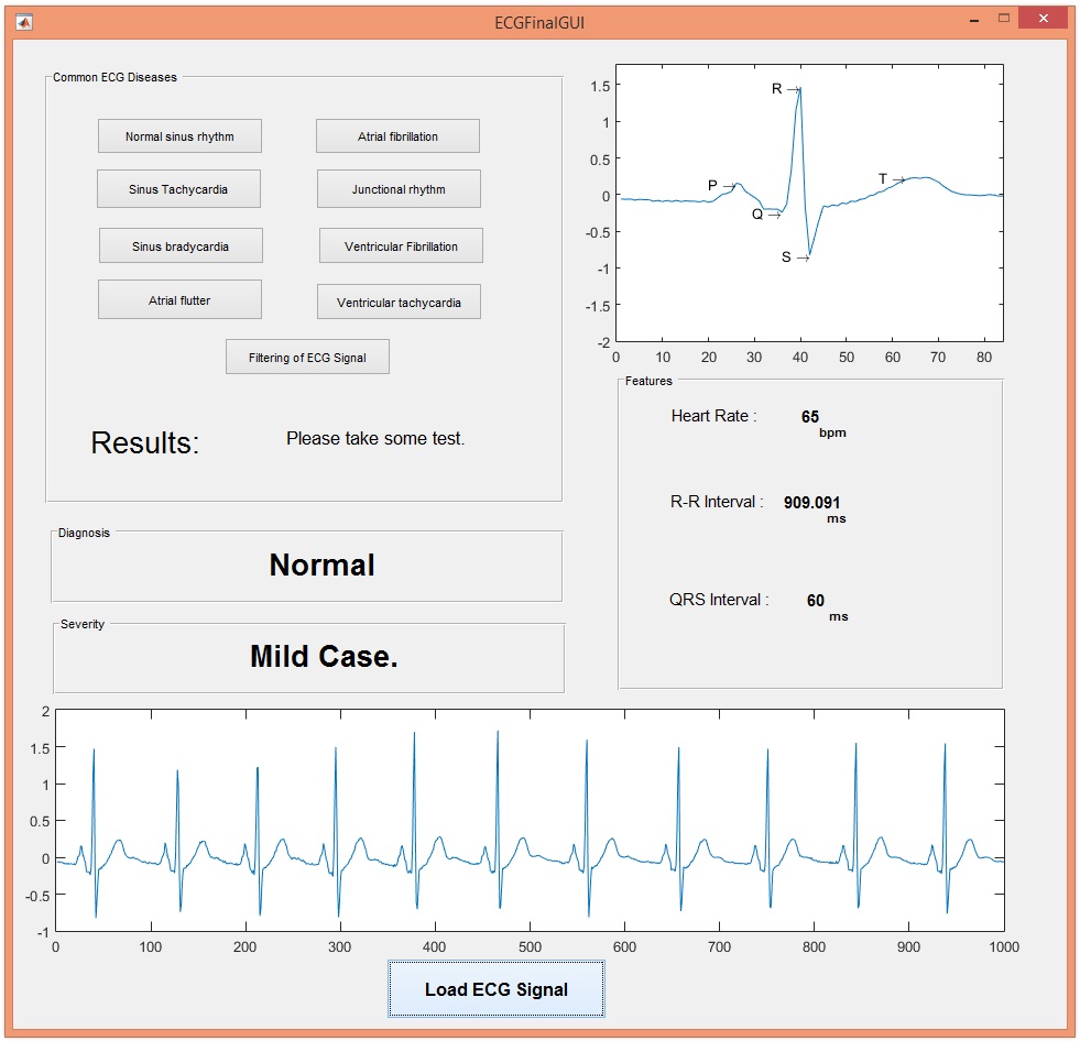 ECG Simulation using MATLAB The Engineering Projects