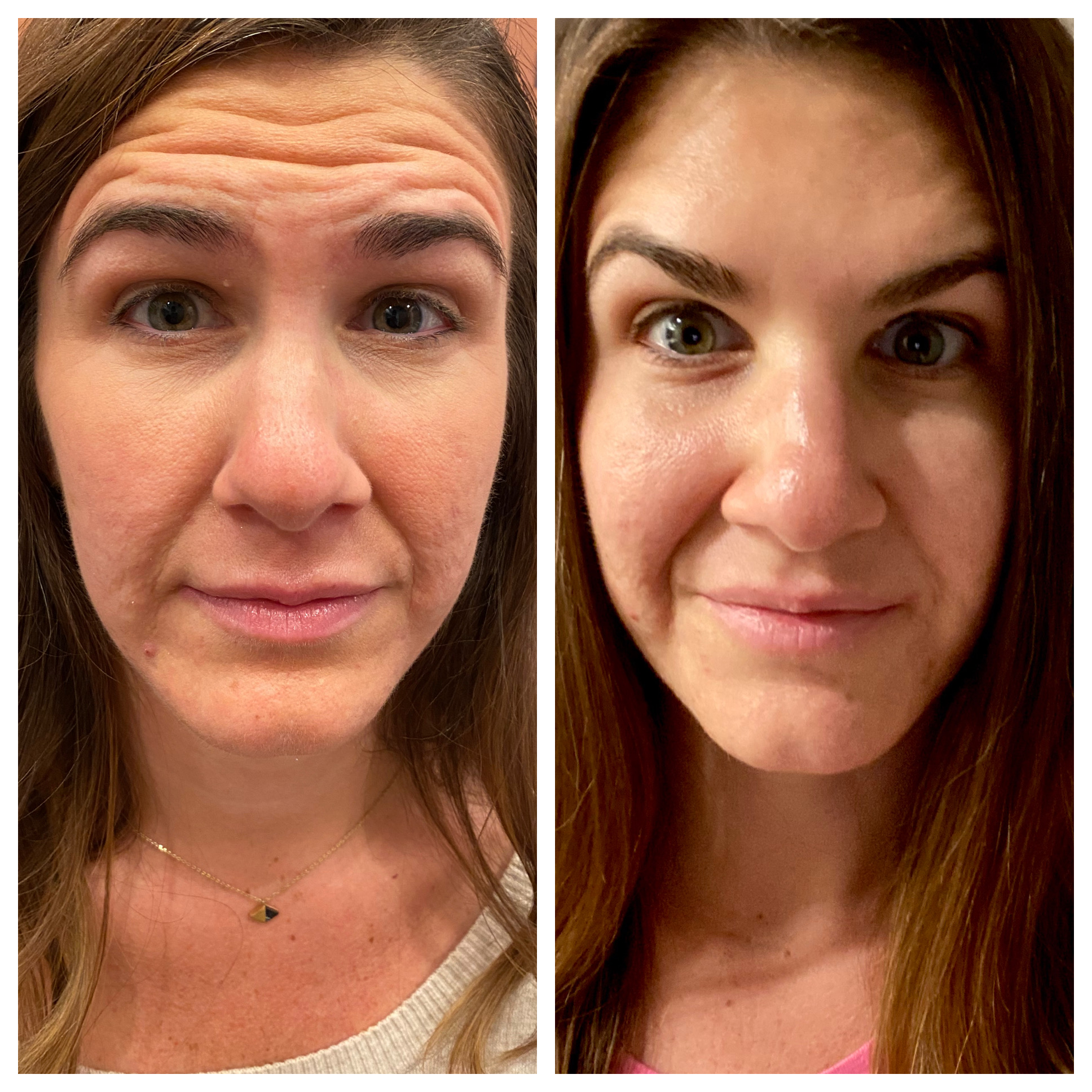 BOTOX Everything You Need to Know + Before & After • TheJJAdventures