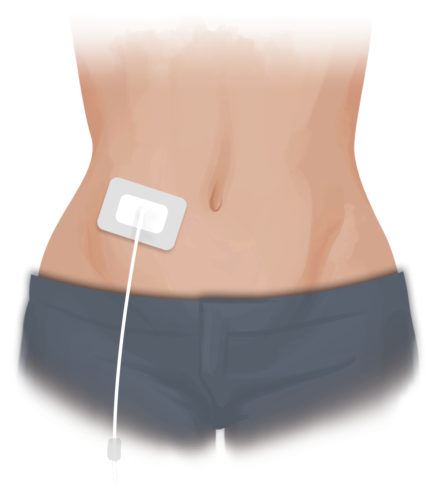 Peritoneal Dialysis Gaytri Manek (Formerly Gandotra), MD