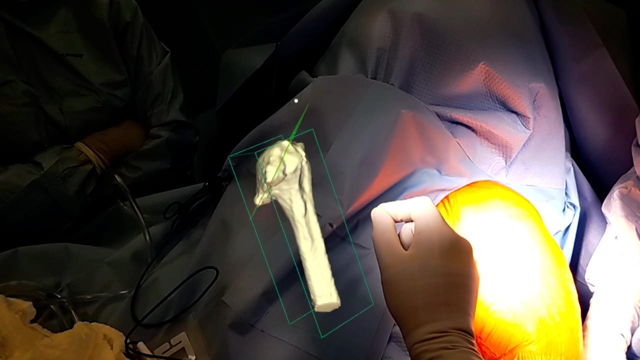 Wexner Medical Center uses holograms for moreprecise shoulder