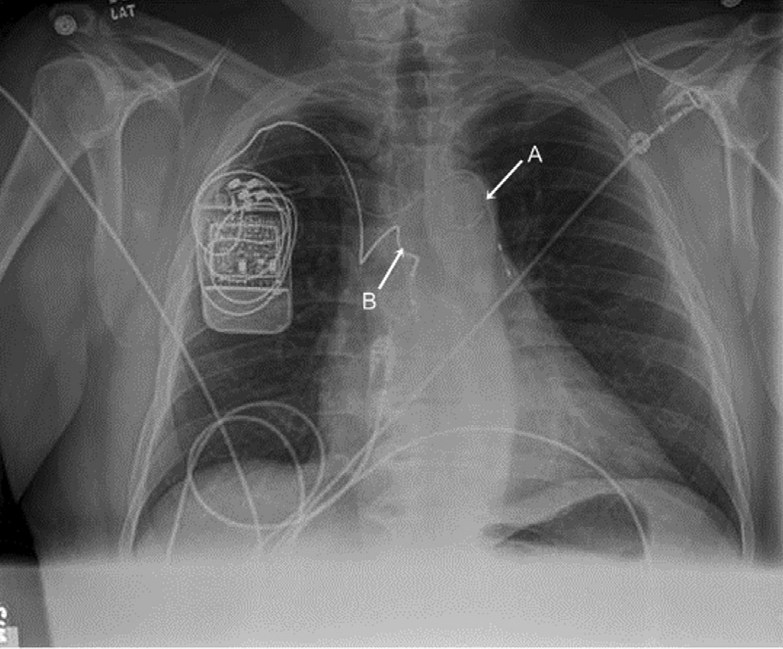 Sleep apnea treatment hailed by OSU researchers The Lantern
