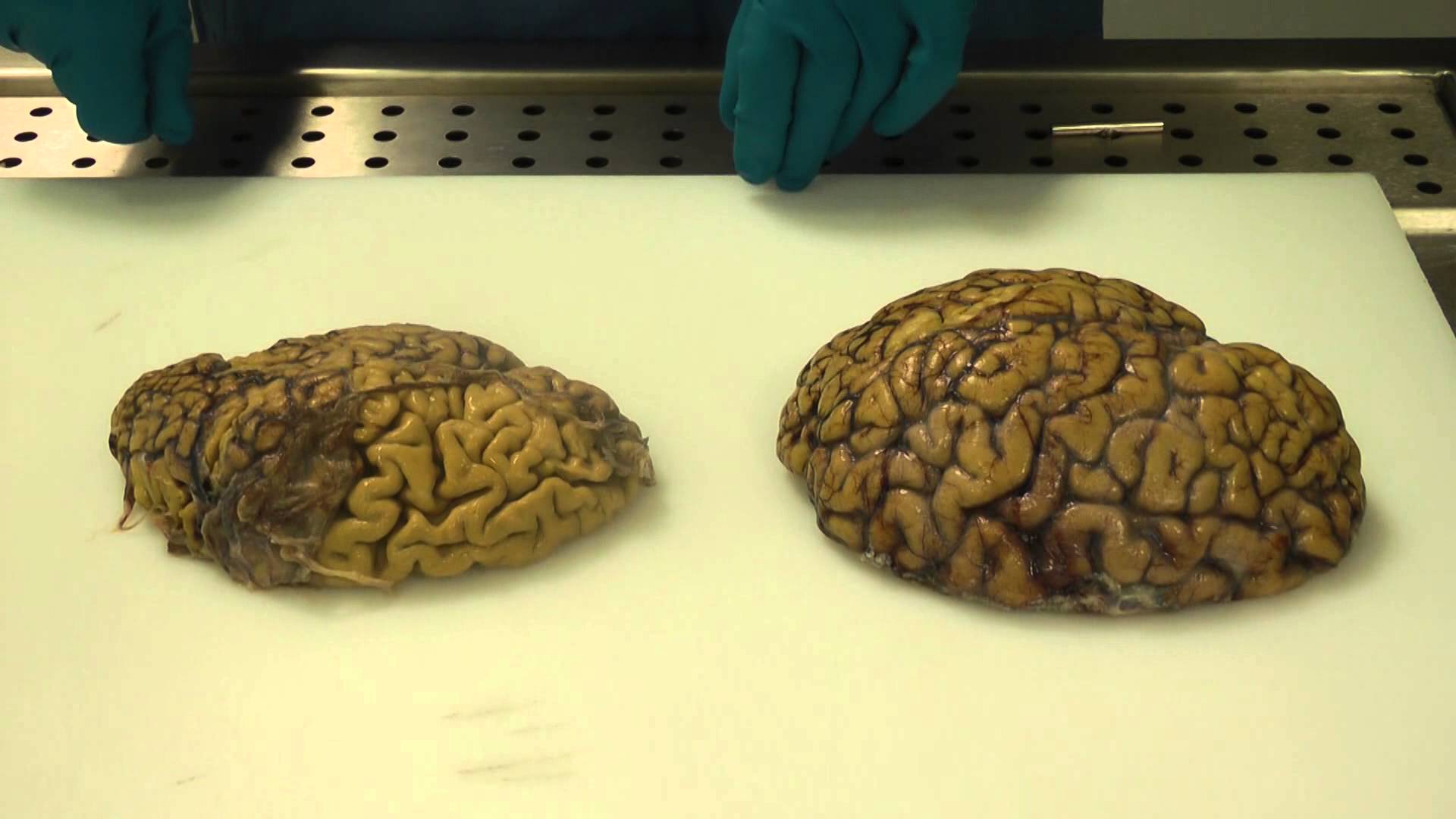 Alzheimer's brain dissection The Mind Voyager