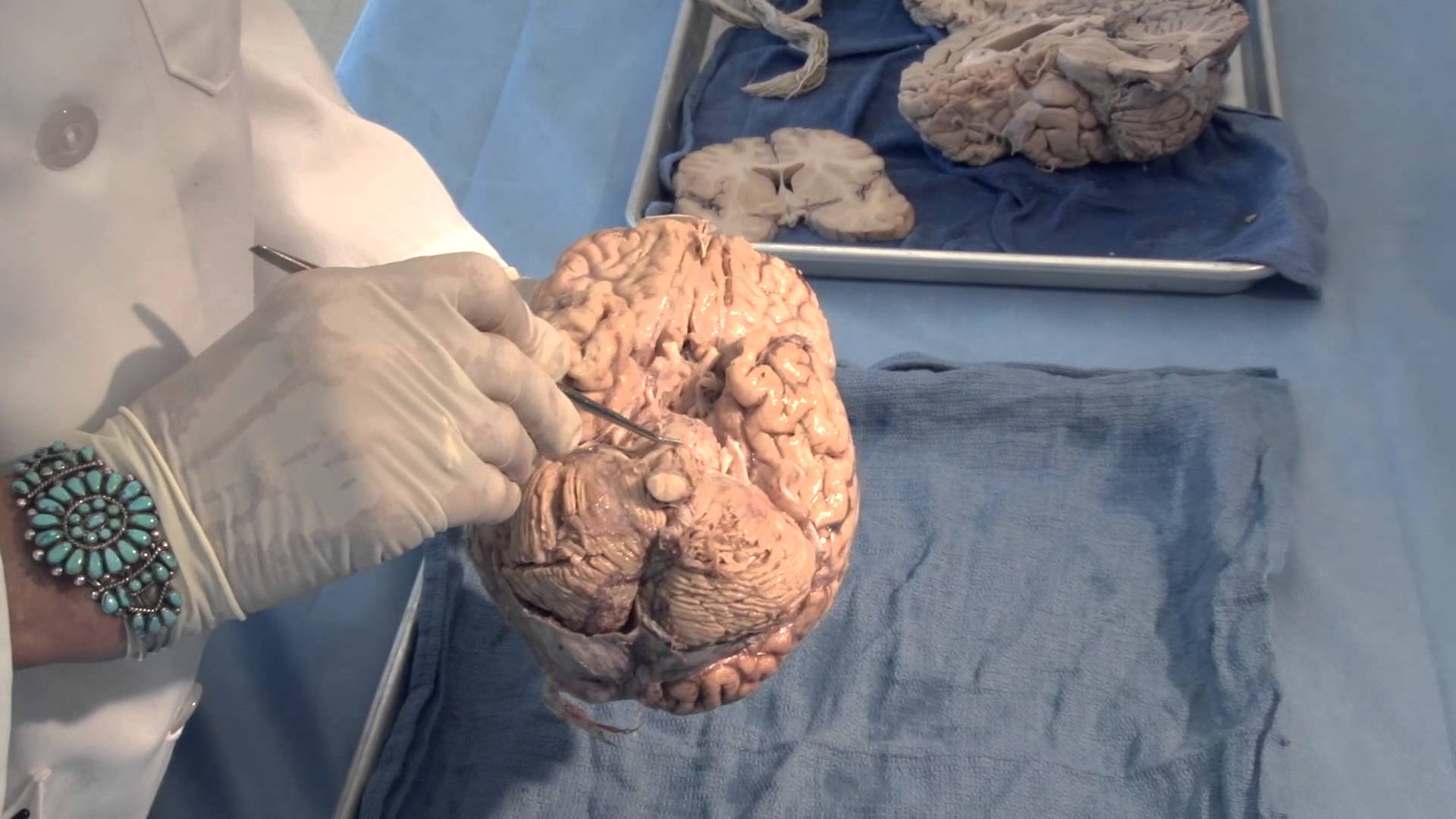 Neuroanatomy Video Lab Brain Dissections Orientation