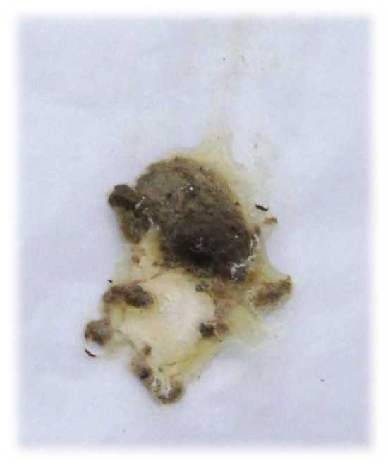 Diarrhea Black Stool Diarrhea