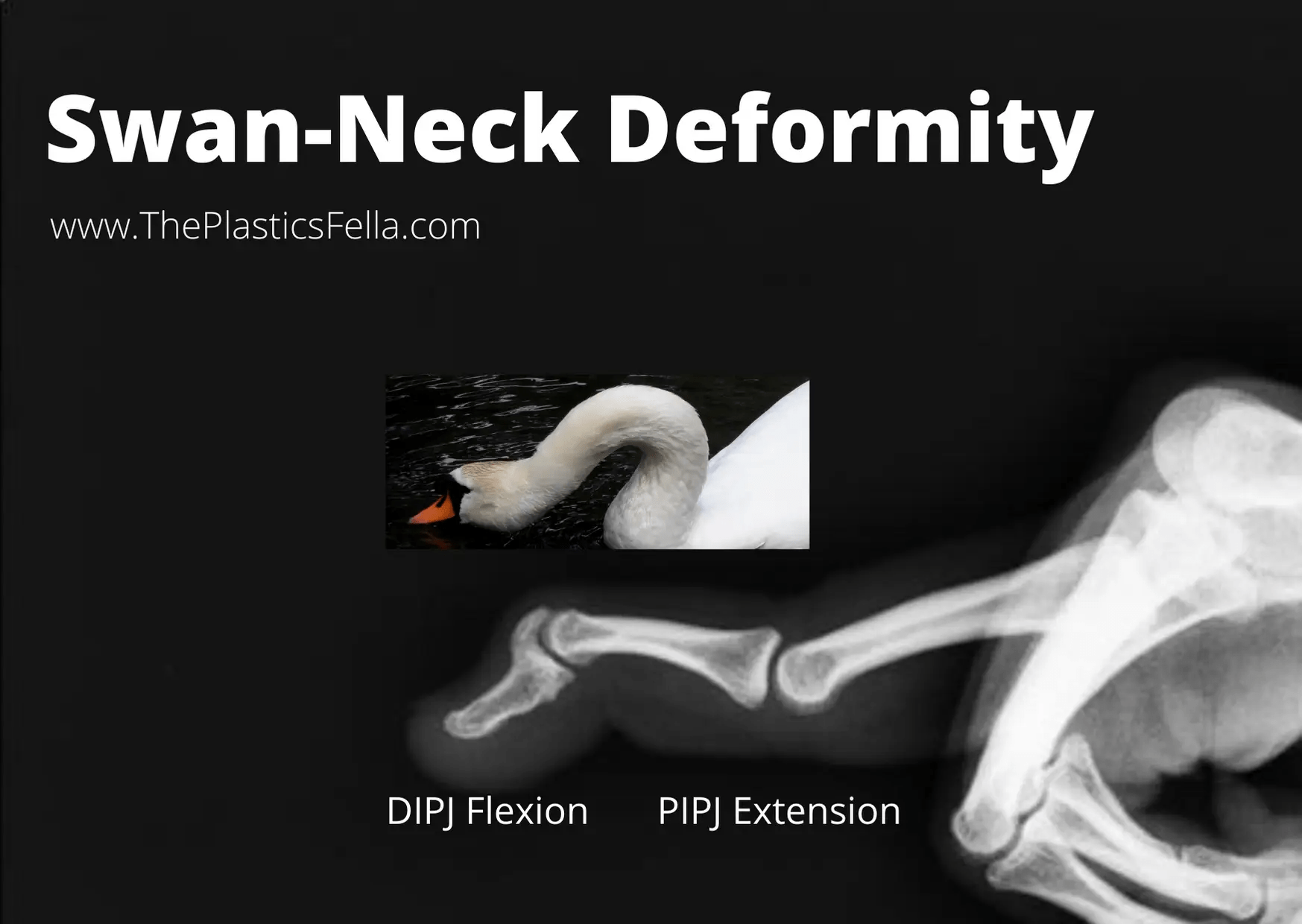 Swan Neck Deformity vs Boutonnières