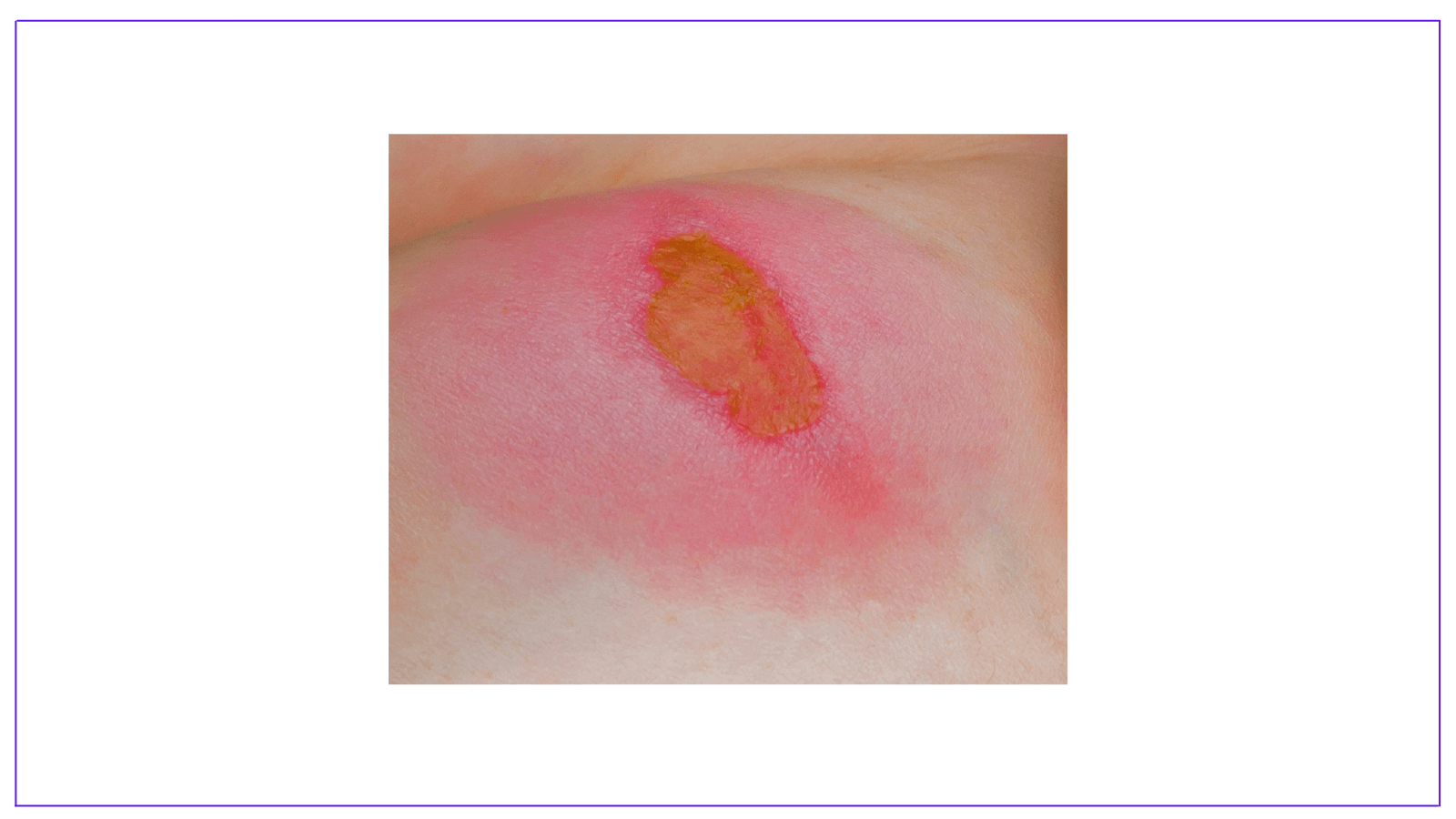 Burn Depth Classification, Assessment, Characteristics.