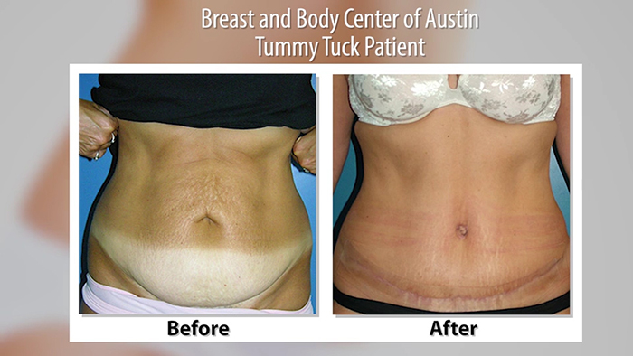 Patients Are Digging the Drainless Tummy Tuck The Plastic Surgery Channel