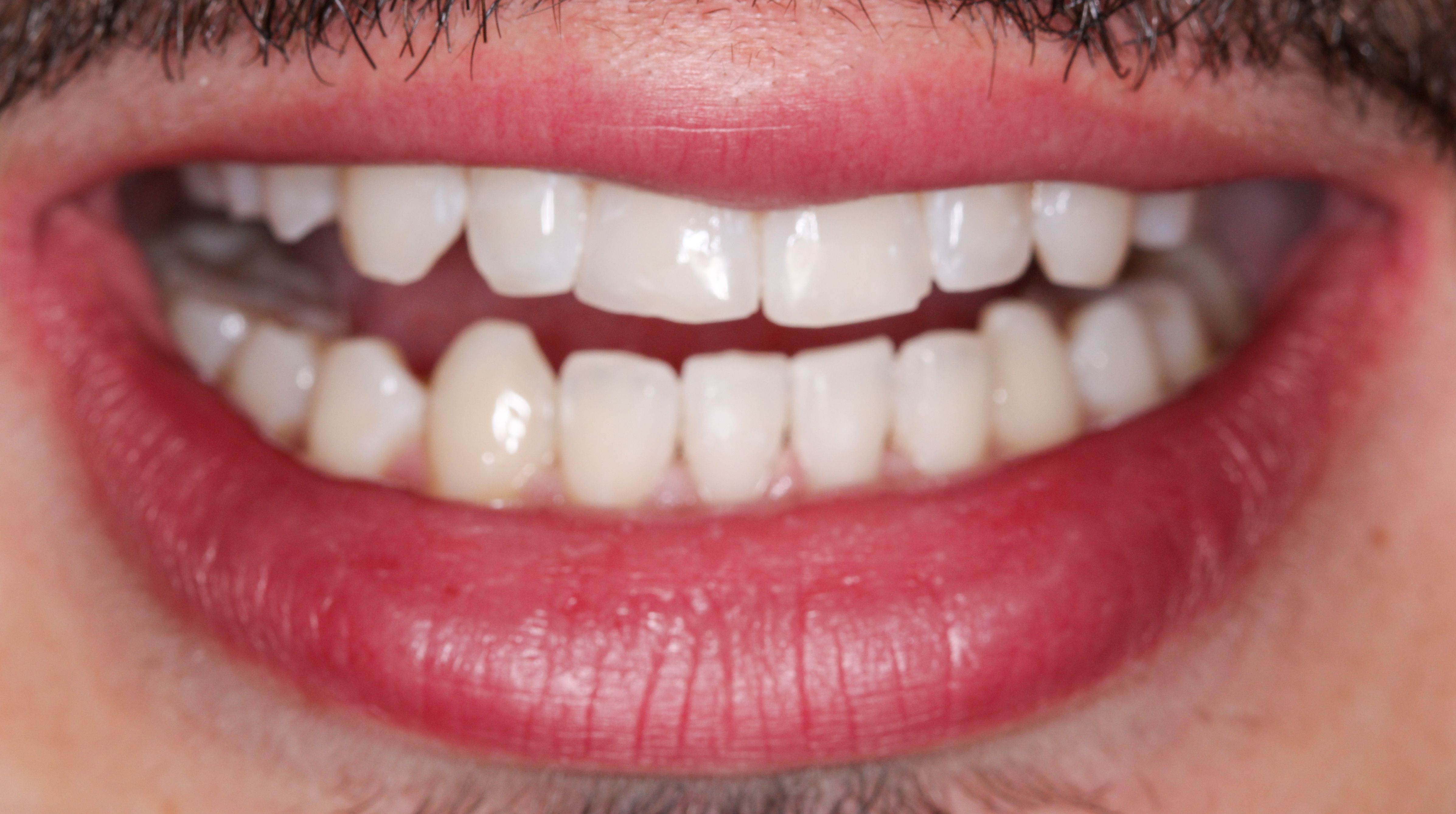 Professional Teeth Whitening in Dubai The Practice Poly Clinic