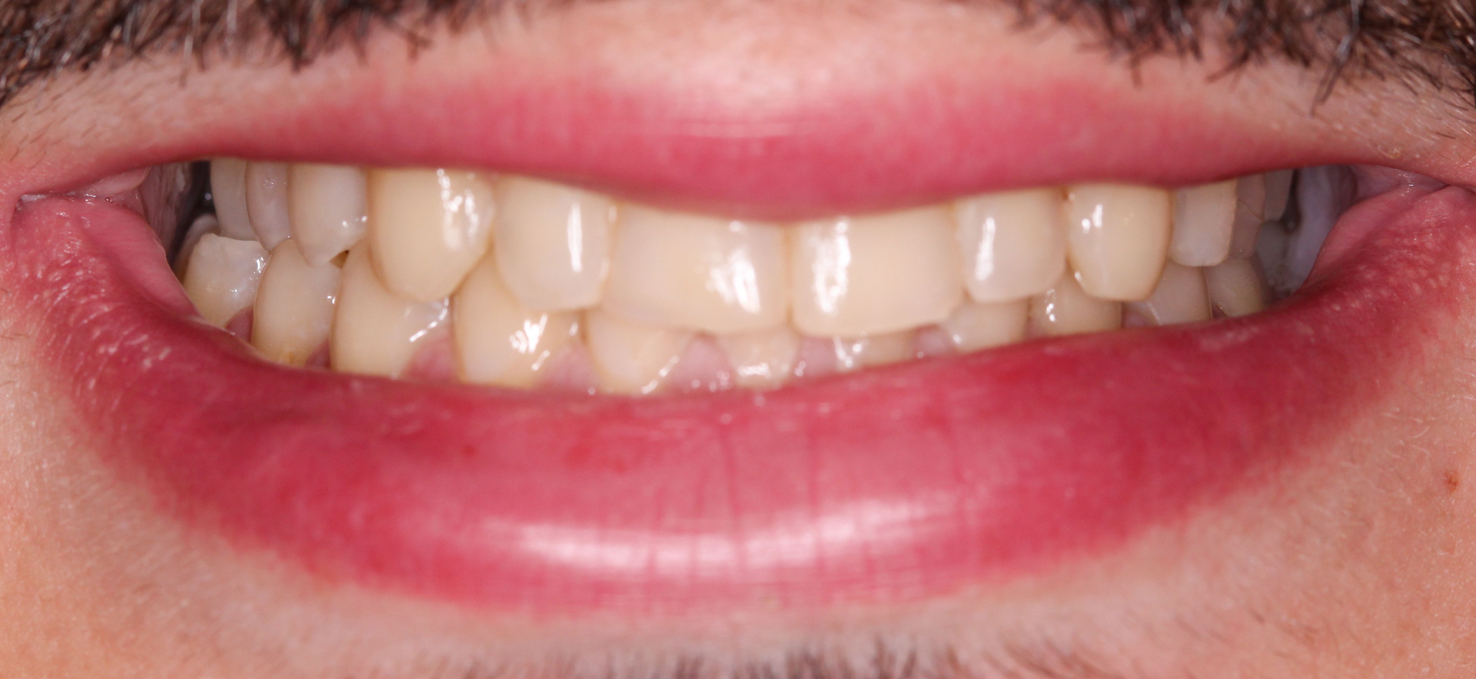 Professional Teeth Whitening in Dubai The Practice Poly Clinic