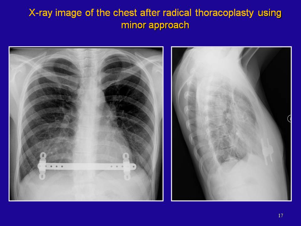 Thorax / Титульная страница / Презентация доклада SURGICAL TREATMENT