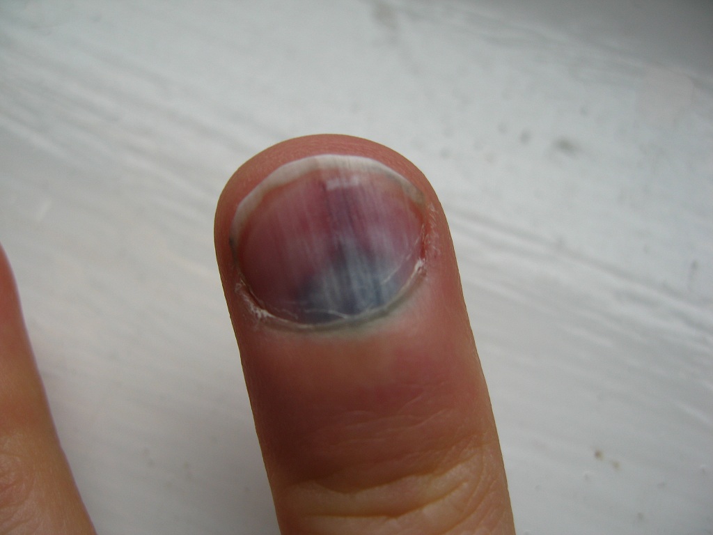 Ow, that hurt. Is my fingernail going to come off? Singletrack World