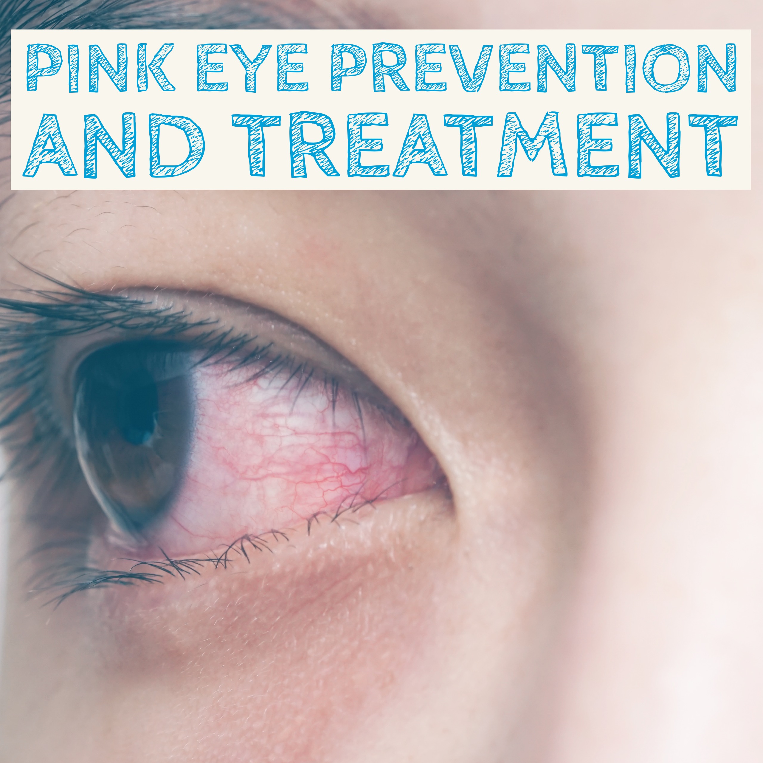 Pink Eye Prevention and Treatment — Thrifty Mommas Tips