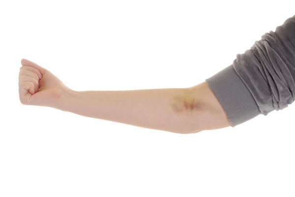 10 Signs of Blood Clot in Arm A Danger To Check For Thrombocytes