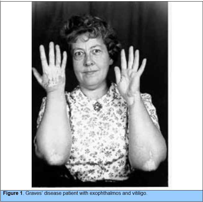 Can You Have Graves Disease Without Weight Loss Travellin