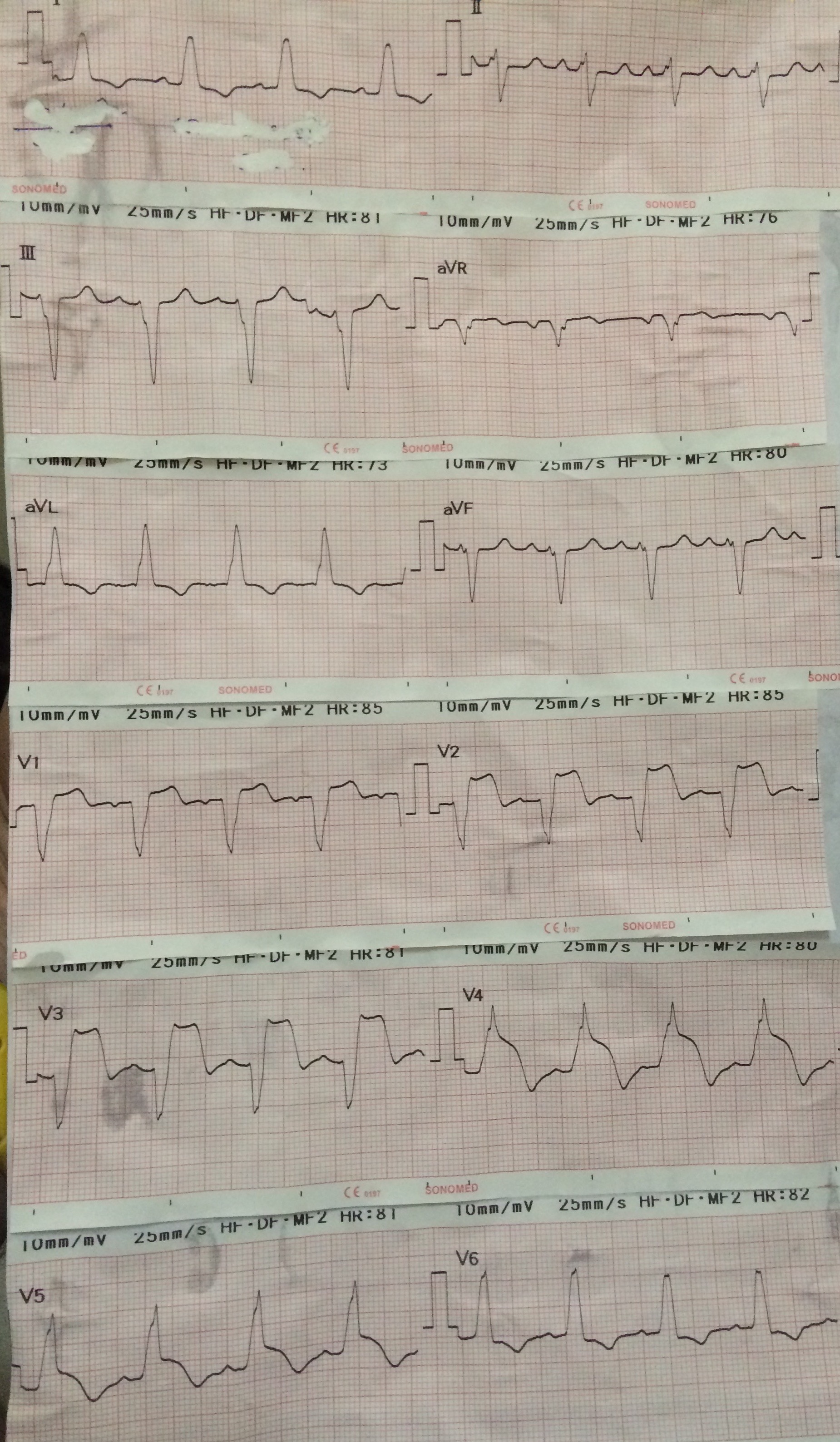 ECG 8 More chest pain! TiCME Time Critical Medical Education