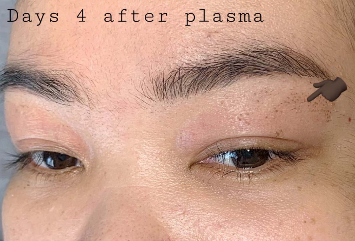 Plasma Eye Lift TimiPretty Eyebrow Microblading Clinic
