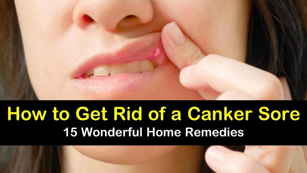 How to Get Rid of a Canker Sore 15 Wonderful Home Remedies
