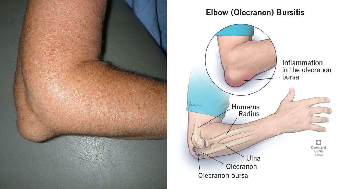 Bodybuilder's Elbow Bursitis, Elbow Growth, Pointy Elbow