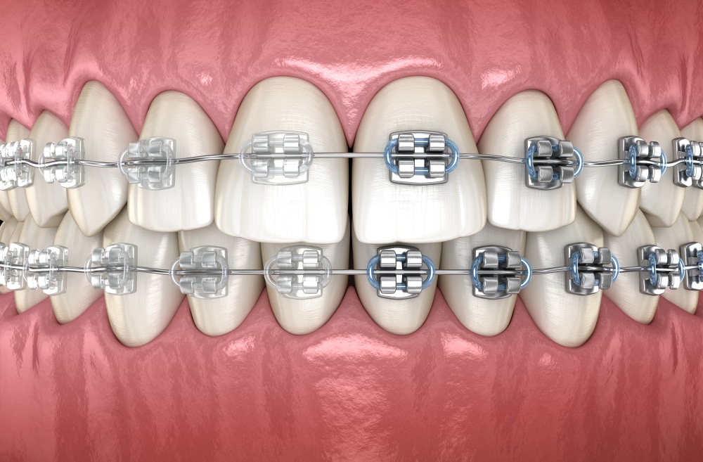 Clear Braces vs Metal Braces Koen Orthodontics