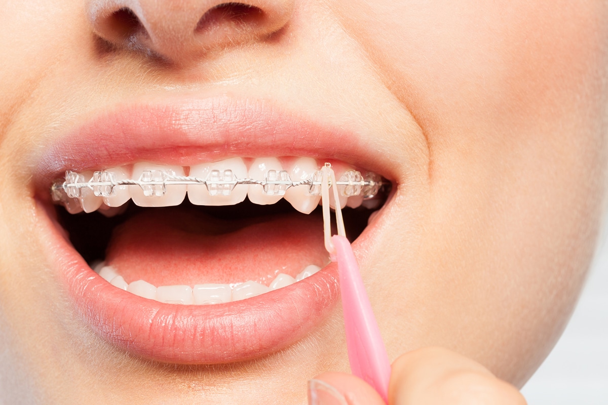 How Much Do Braces Cost For Kids In Grapevine, TX? TMJ Plus Wellness