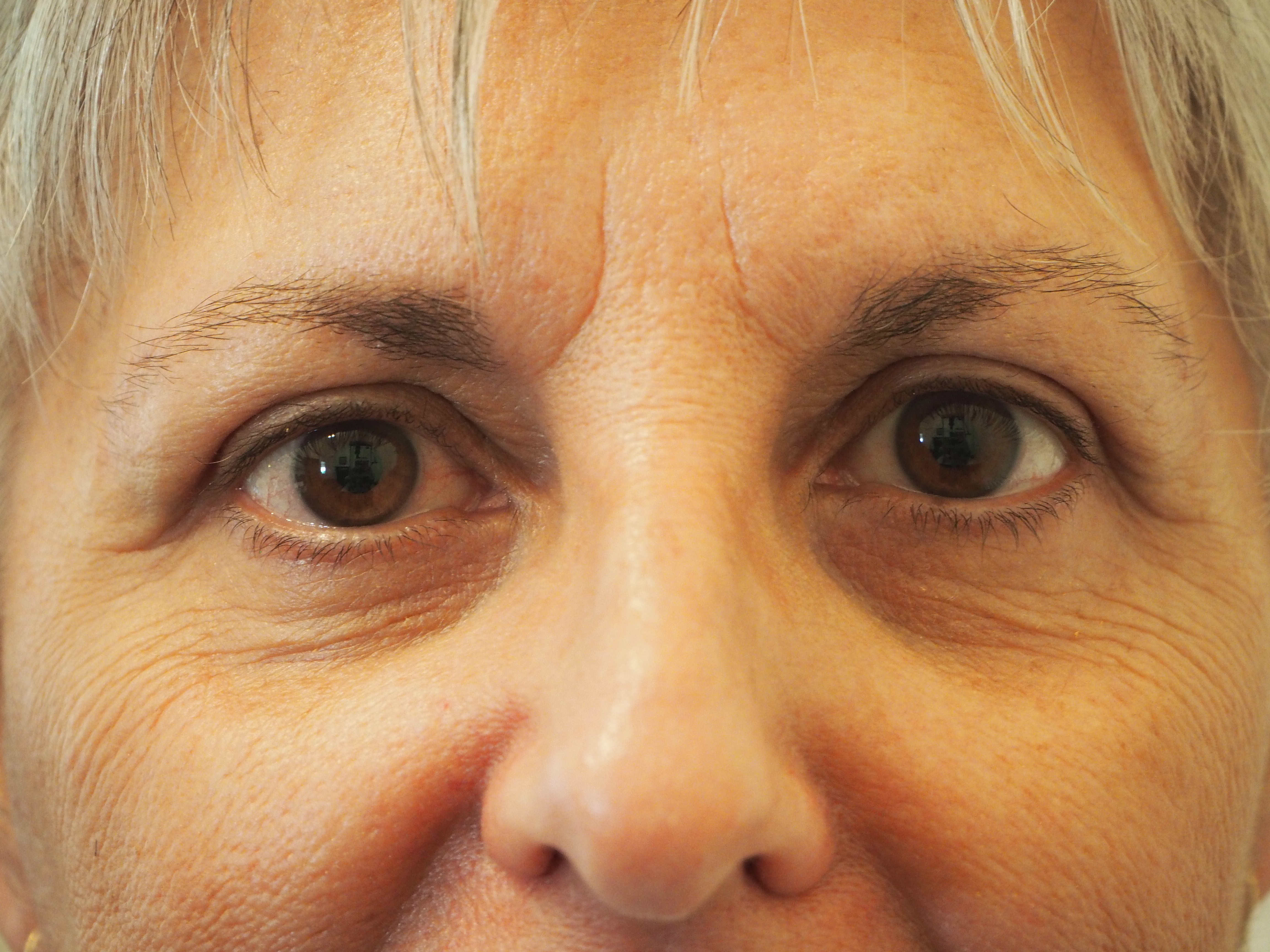 Eyelid surgery Dr Tom Cunneen Eye Surgery Perth