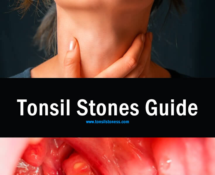 7 Natural Home Remedies to Cure Tonsil Stones [2022]