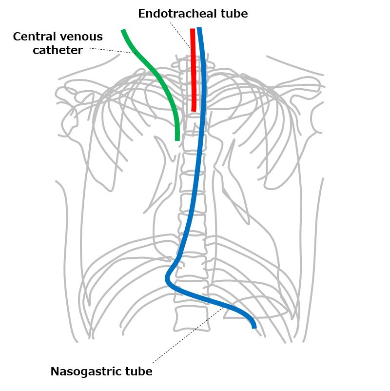 Chest AP view (portable)｜Tools for RadTech