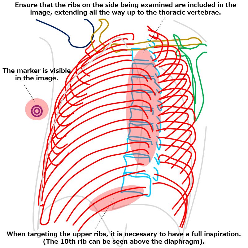 Ribs oblique view, Axillary ribs｜Tools for RadTech