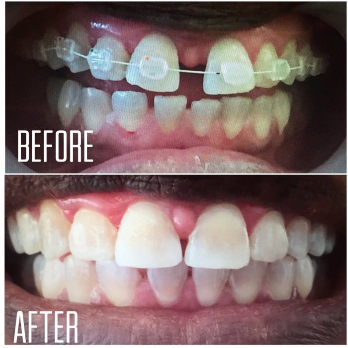 How Old Do You Have to Be to Get Invisalign®? Coastal Dental.
