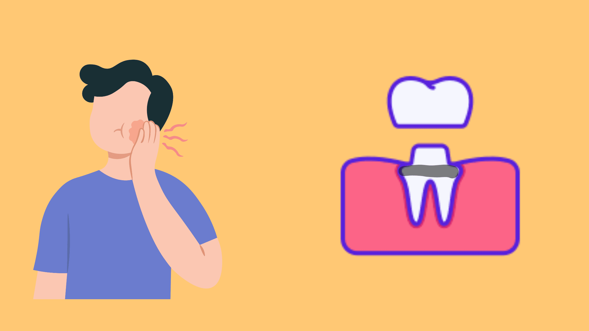 Revealing cavities under a crown What you need to know