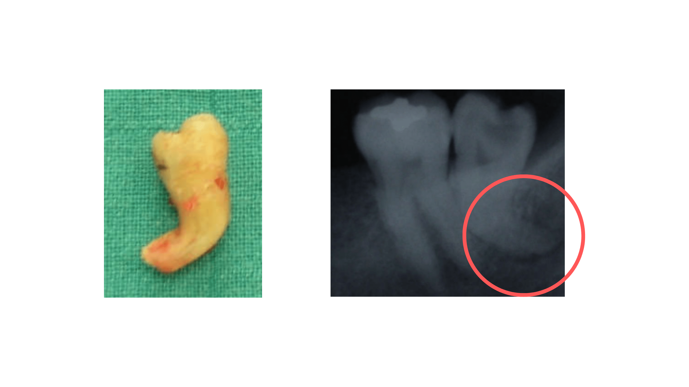 Tooth Extraction Everything You Need to Know