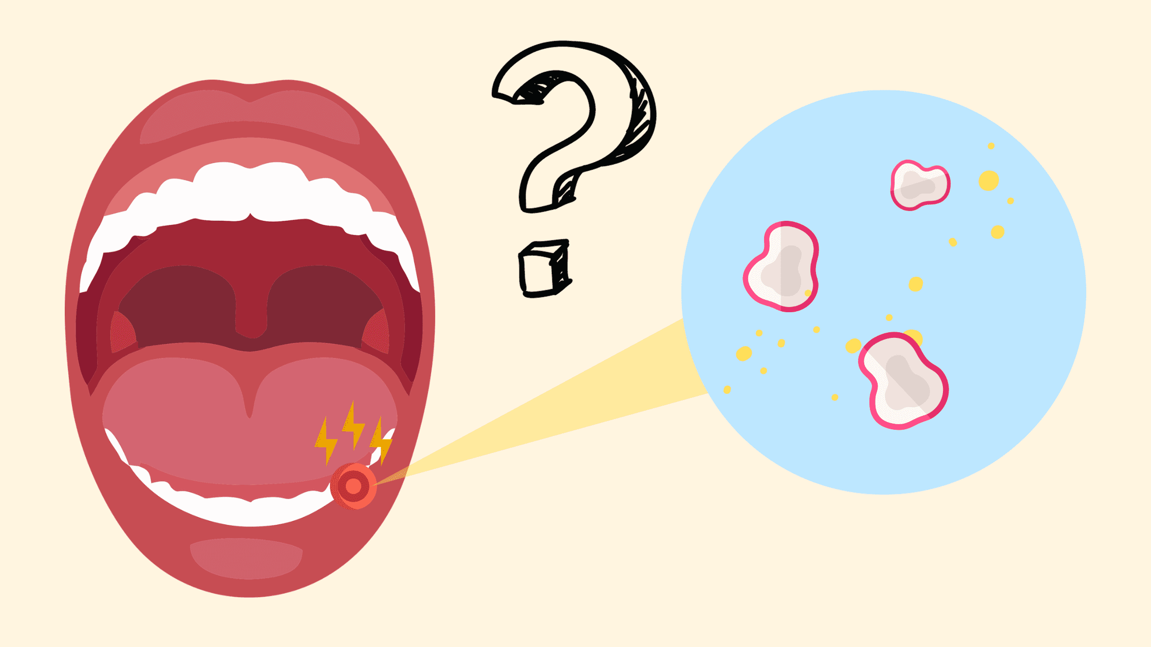 5 Potential Causes of Multiple Canker Sores at Once