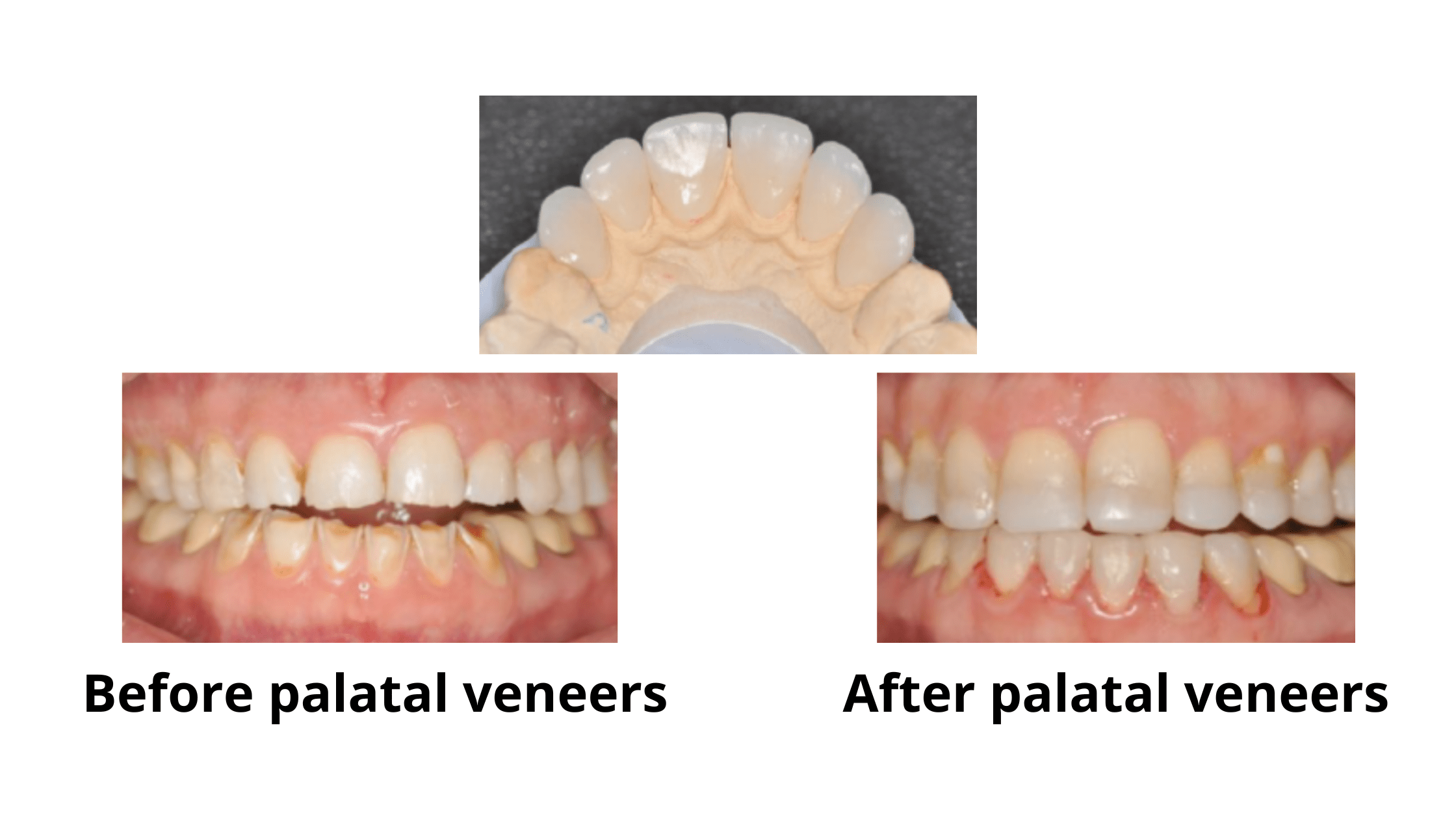 How to fix worn down front and back teeth (2 steps with pictures)