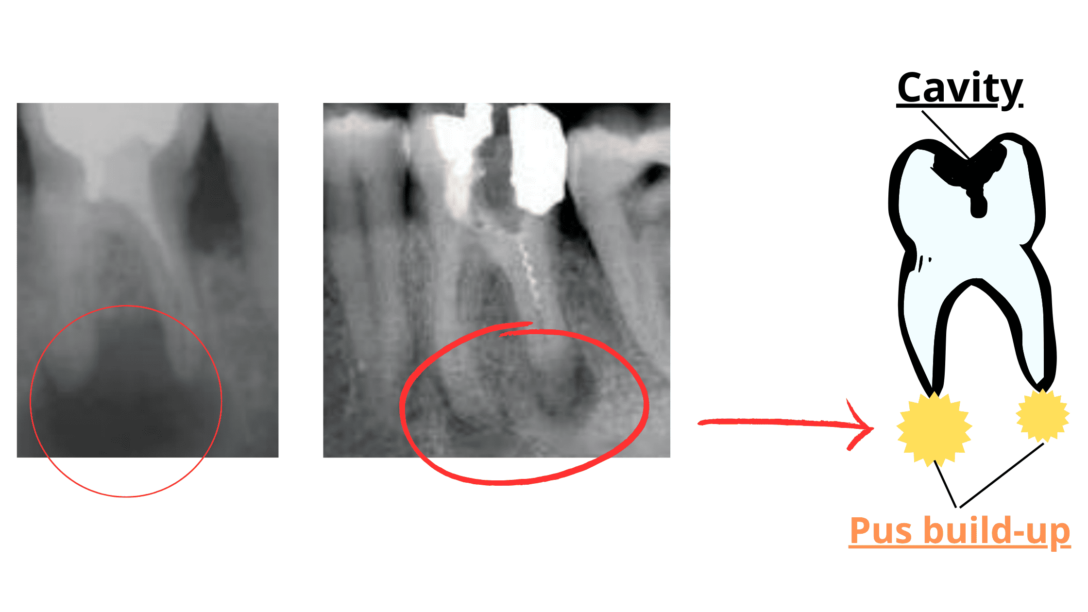 Abscess under Root Canal Don't Ignore It!