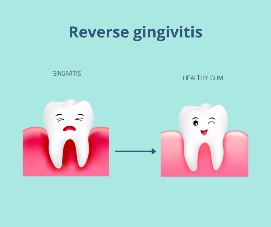 Yes, You Can Reverse Gingivitis at Home Here's How