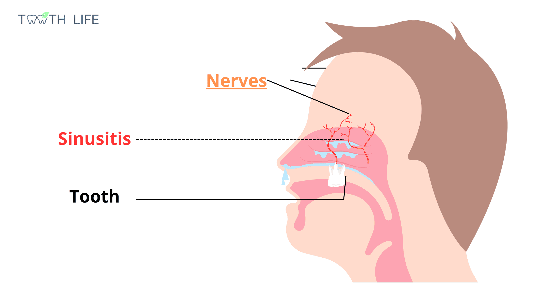 Sinus Tooth Pain Understanding the TwoWay Relationship