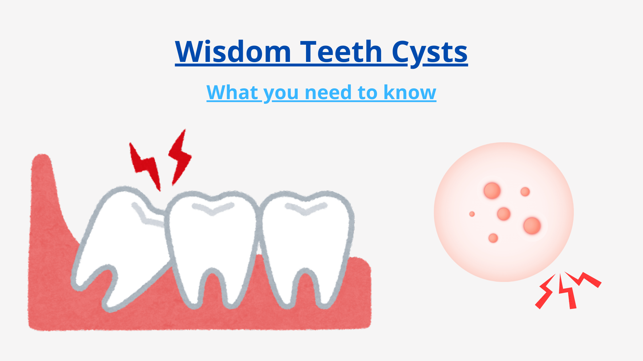 Wisdom Tooth Cyst A Potential Complication Explained