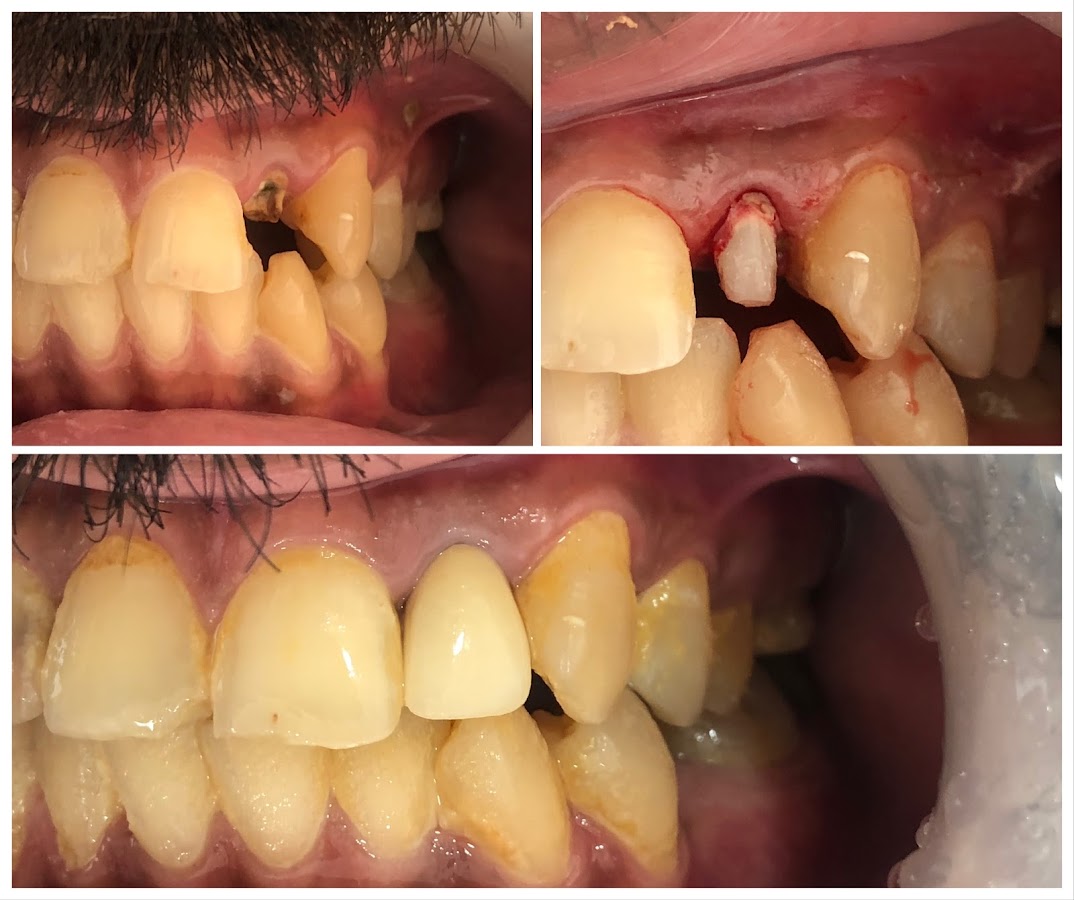 Dental Treatment Post and Cores in Endodontics Hyderabad Toothdocs